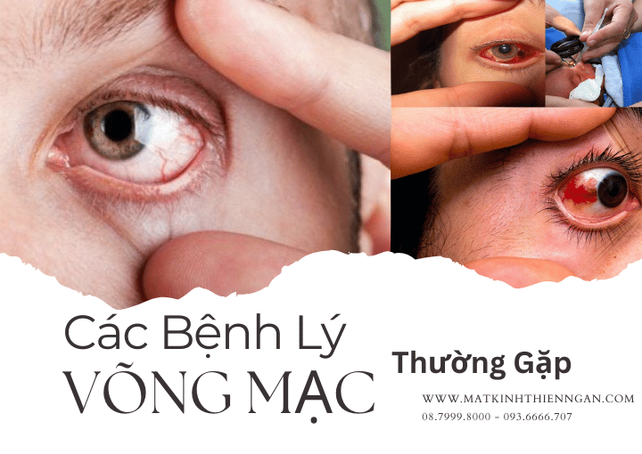 Võng mạc là gì? Các bệnh lý về võng mạc thường gặp